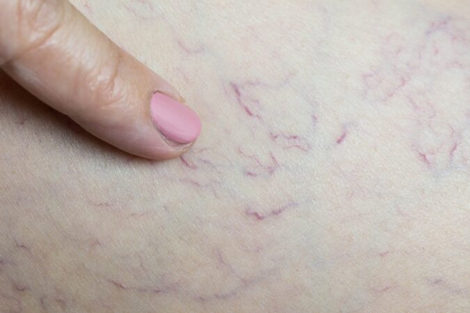varicose veins in pregnancy