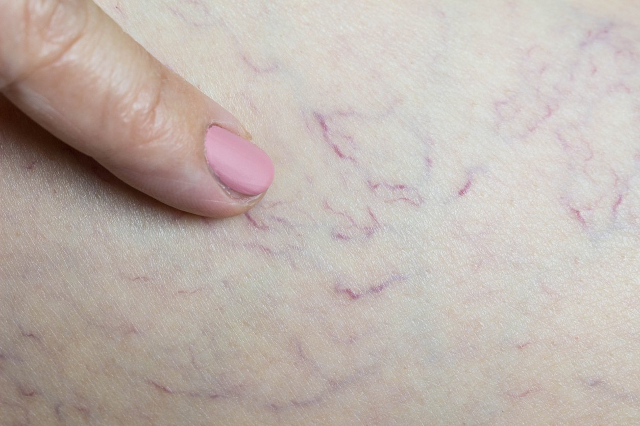 What You Need to Know About Varicose Veins in Pregnancy ...